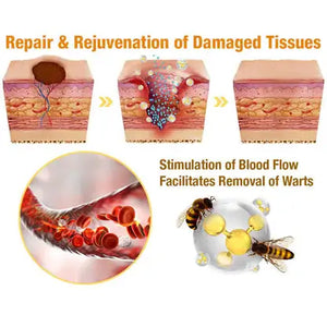 Medilisk™ Bee Venom Wart Remover Spray ⭐️⭐️⭐️⭐️⭐️4.8/5 (1600+ REVIEWS)