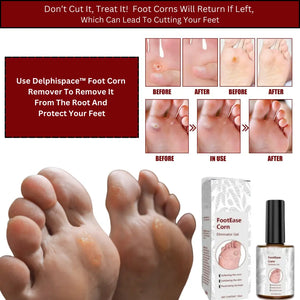 Delphi Space™ Footease Corn Remover Gel⭐️⭐️⭐️⭐️⭐️4.8/5 (7,600+ REVIEWS)
